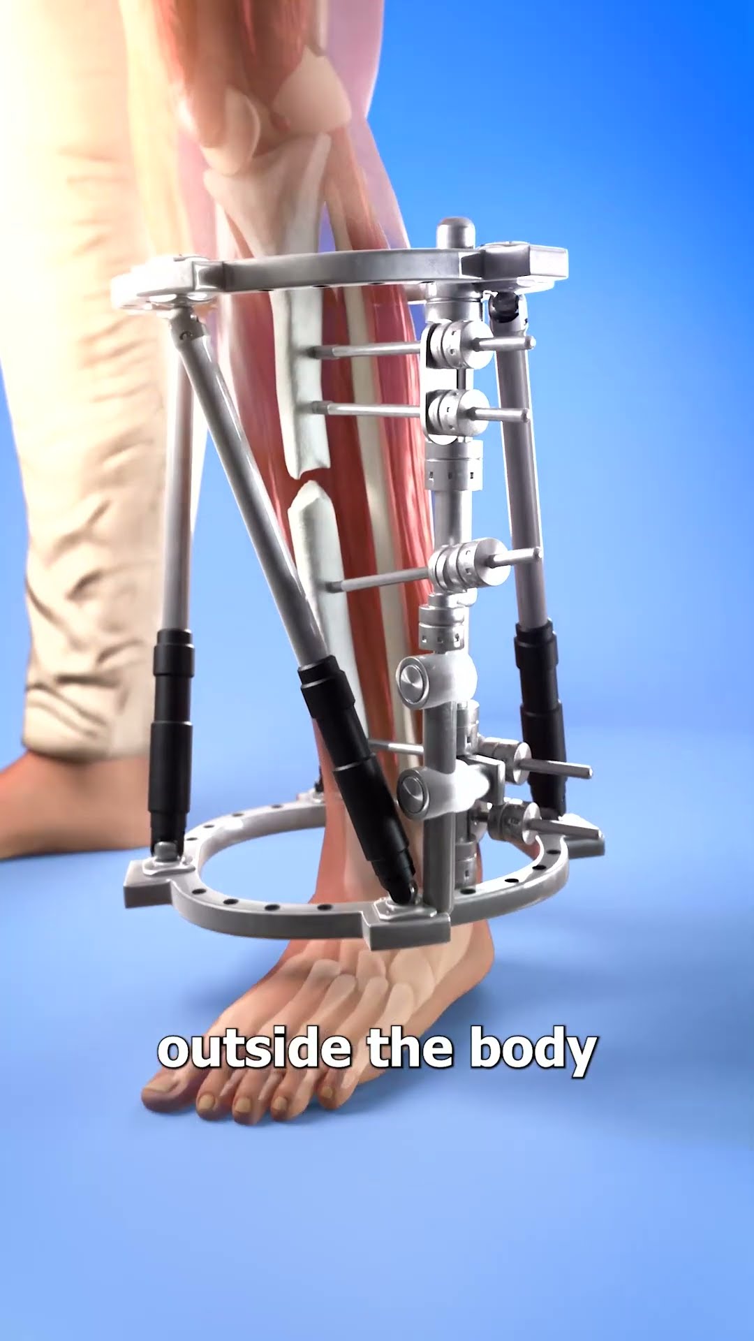 How To Stabilize A Broken Bone ?