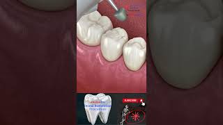 Dental Restoration ↪ Composite Bonding Teeth  ↪ 3D Medical Animation screenshot 1