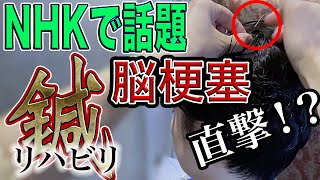 【NHKで話題　脳梗塞　鍼治療】リハビリに頭皮の鍼をすると…びっくり！鍼治療