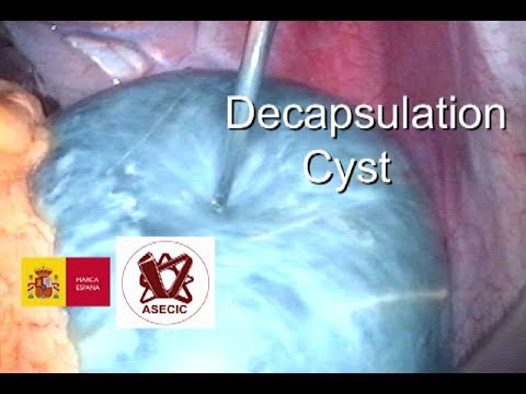 Video: Spleen Cyst