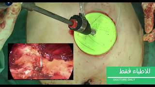 EMILOS  Endoscopic mini/less open sublay  hernia repair اصلاح الفتاق المتكرر بالمنظار