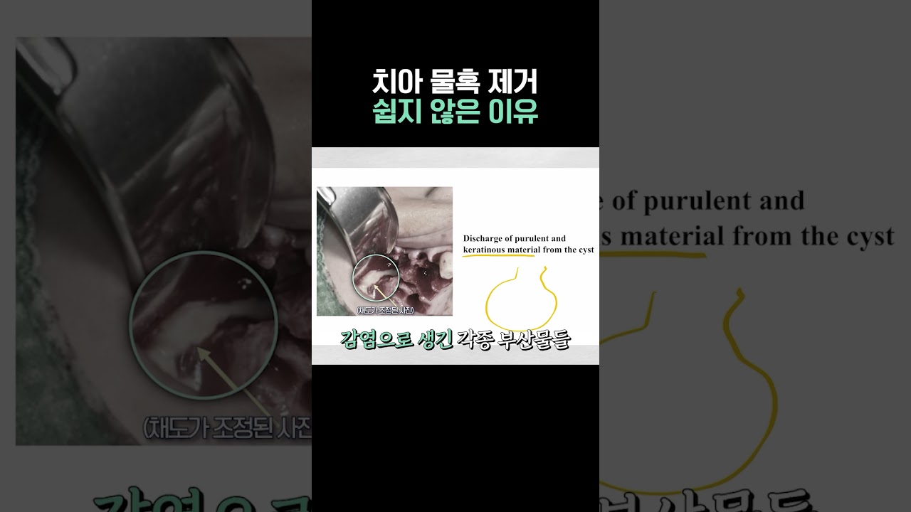치아 물혹 제거 쉽지 않은 이유