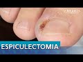 ESPICULECTOMIA | PODOLOGIA