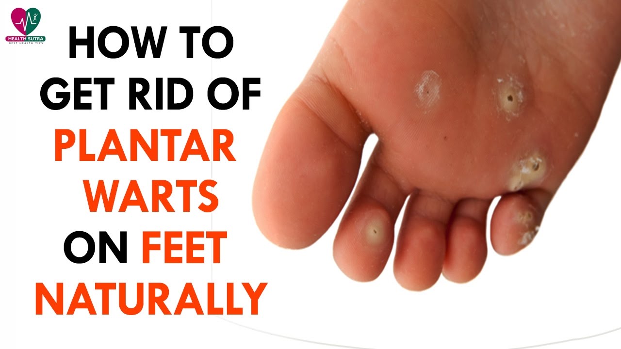 How To Get Rid Of Plantar Warts On Feet Naturally - Health Sutra - YouTube