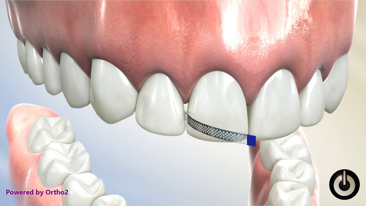Interproximal Reduction with Diamond Strip Dental Braces Temecula