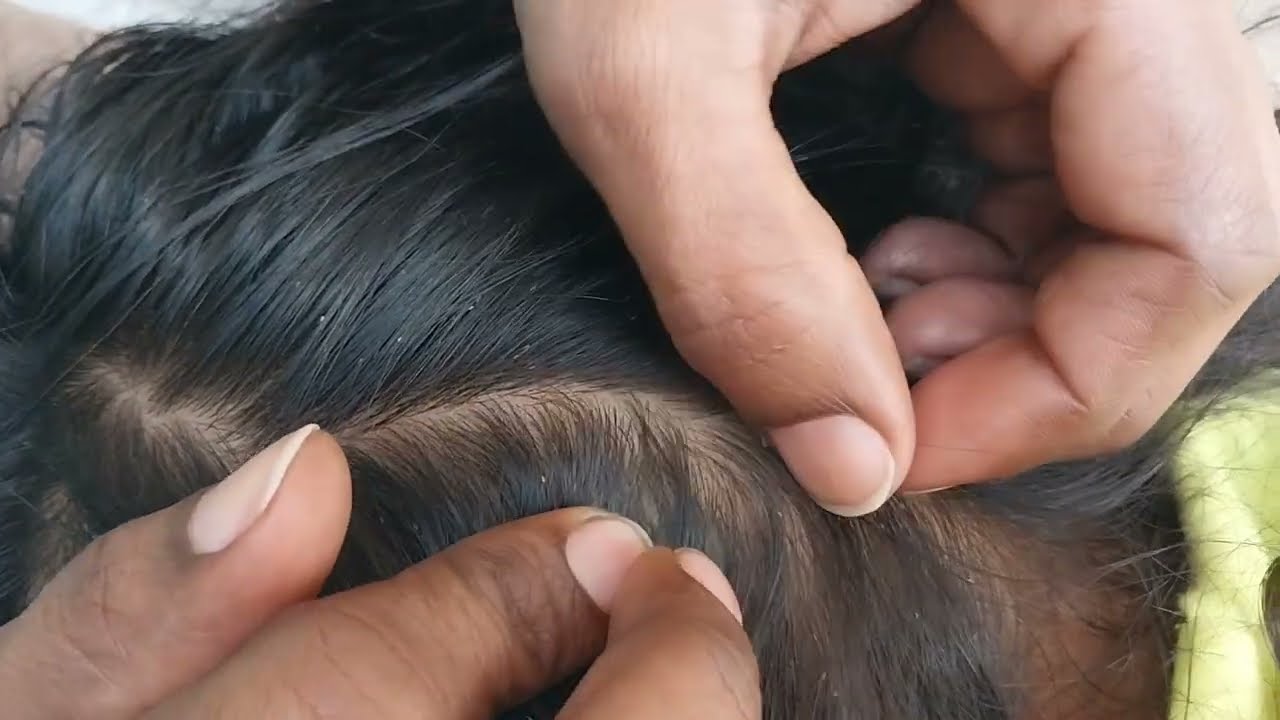 Nitpicking ASMR video 183 