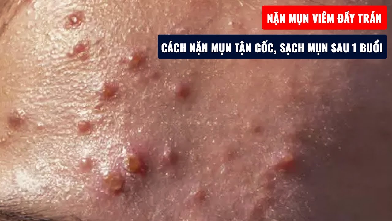 Nặn mụn viêm đầy trán - Cách nặn mụn tận gốc, sạch mụn sau 1 buổi