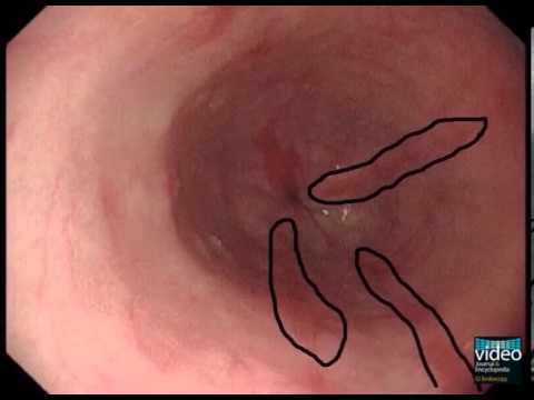 The Los Angeles Classification of Gastroesophageal Reflux Disease - YouTube