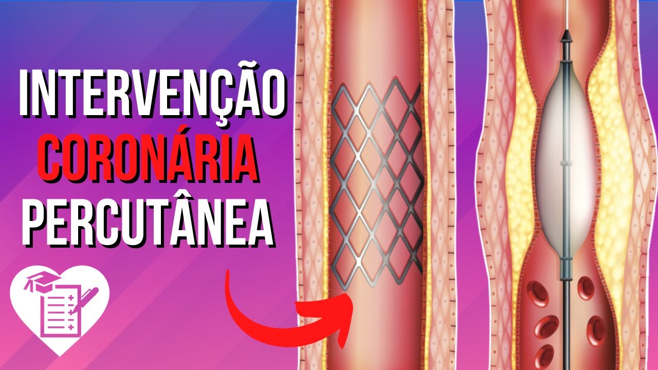 ANGIOPLASTIA Tudo o que você quer saber YouTube ANGIOPLASTIA Tudo o que você quer saber YouTube