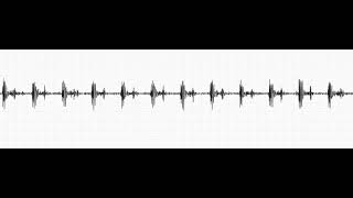 Mitral Regurgitation And Mitral Stenosis 4