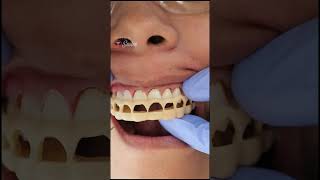 Gum Contouring & Dental Veneers by Houston's Top Cosmetic Dentist