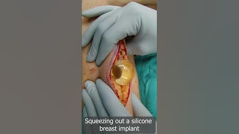 Squeeze Out Your Silicone Breast Implant Safely - Removal of Breast Implant - Squeezing Out Silicone
