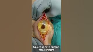Squeeze Out Your Silicone Breast Implant Safely - Removal of Breast Implant - Squeezing Out Silicone