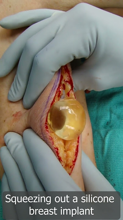 Squeeze Out Your Silicone Breast Implant Safely - Removal of Breast Implant - Squeezing Out Silicone