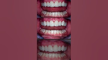 Video Preview! Creating a Smile Makeover Treatment Plan with Composite Bonding