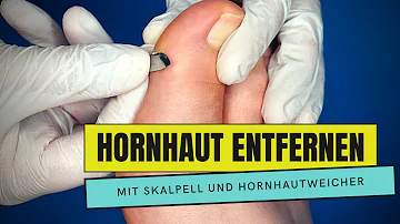 Wie bekommt man Hornhaut am großen Zeh weg?