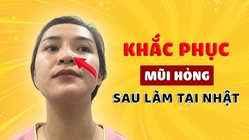 Sửa mũi hỏng – Khắc phục mọi biến chứng sau khi nâng mũi | BS Tuấn Dương