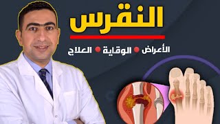 أعراض النقرس وعلاجه | ٦ طرق للوقايه من زيادة أملاح اليوريك اسيد والتهاب المفاصل