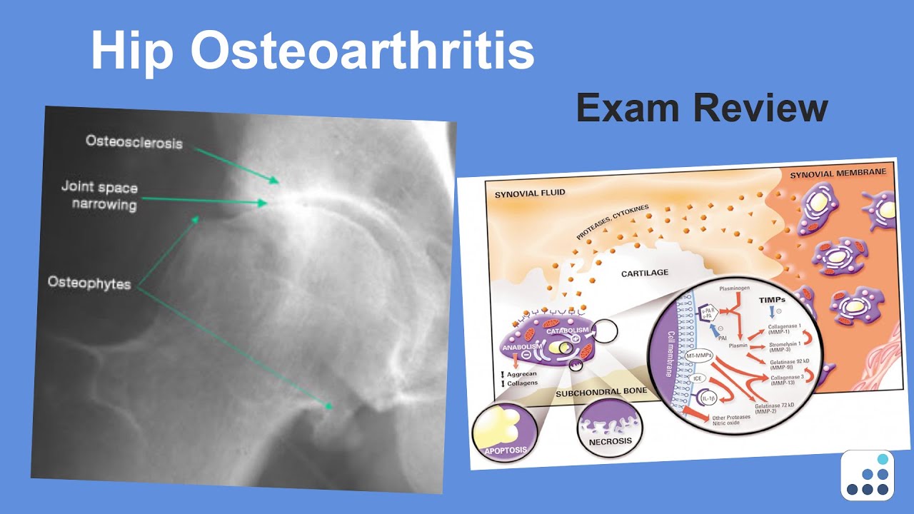 Hip Osteoarthritis Exam Review William Jiranek, MD YouTube