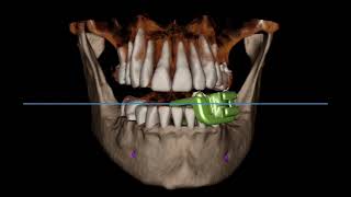 IconiX AI for X-Guide: AI-Powered Acceleration for your Navigated Implant Surgeries (short preview)