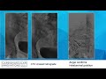 Access site selection to treat aortoiliac disease, retrograde, brachial, radial - Peter Soukas, MD