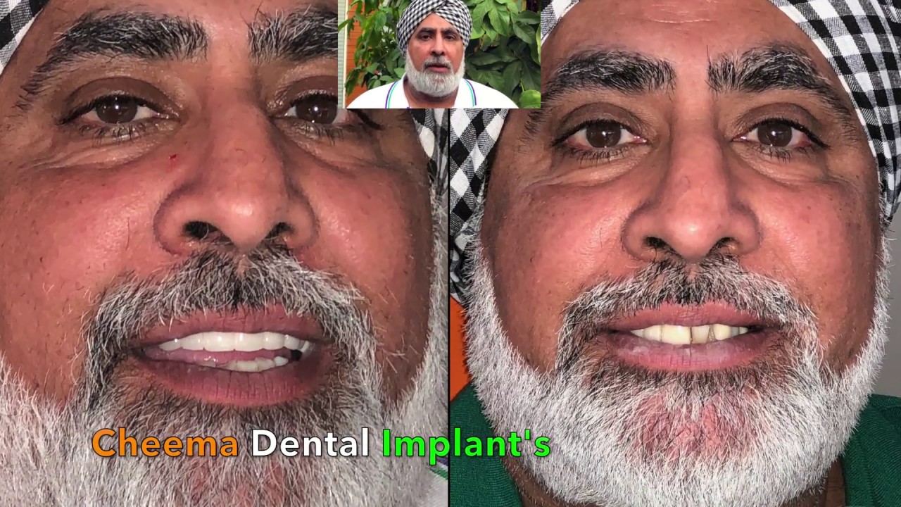 teeth zirconium implants whitening jalandhar procedure of