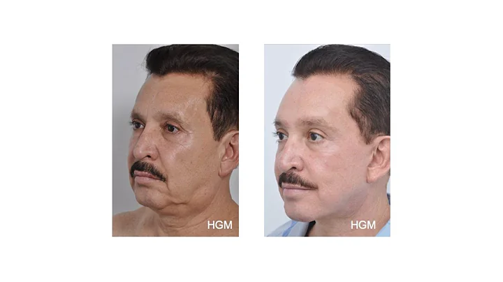 Learn from Dr.Hector G. Miramontes, master of the SMAS facelift, using deep plane approach