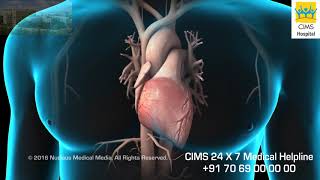 About Your Heart Attack - CIMS Hospital