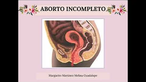 ¿Es doloroso un aborto incompleto?