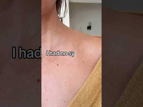 Swollen Lymph Nodes In Elbow Crease