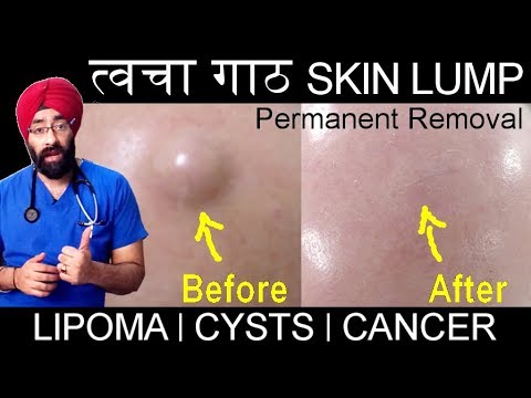 permanently-remove-skin-lump-|-त्वचा-गाठ-|-it-can-be-lipoma,-cysts,-cancer-|-in-hindi-|-dr.education