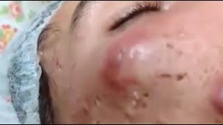 Big Acne, Pus on face pop out      Really hurt and terrified!!