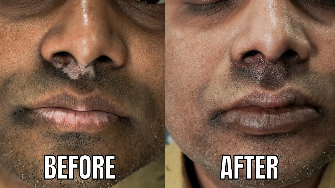 LIP VITILIGO TREATMENT IN INDIA / LIP VITILIGO PIGMENTOZ TREATMENT/ LIP