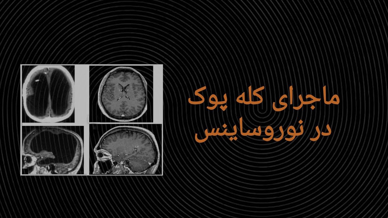 معجزه ای در نوروساینس ـ کله پوک