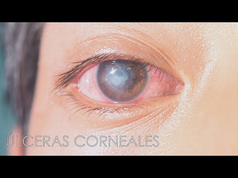 วีดีโอ: Ulceración de la Córnea