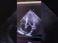 Posterior Mitral Leaflet SAM+ in an HOCMP patient treated with septal alcohol ablation 2 months ago