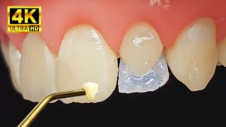Incredible Peg Lateral Restoration | Satisfying Video