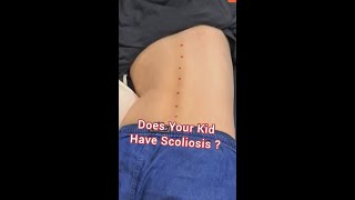 ️SCOLIOSIS CHECK UP