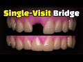Single-Visit Bridge (Ribbond)