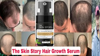 The Skin Story Hair Growth Serum Review