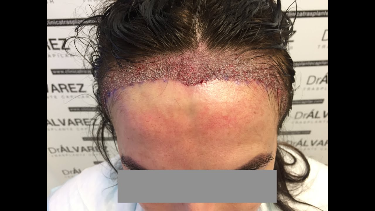 Injerto capilar mujer, Trasplante capilar mujer, Woman hair trasplant