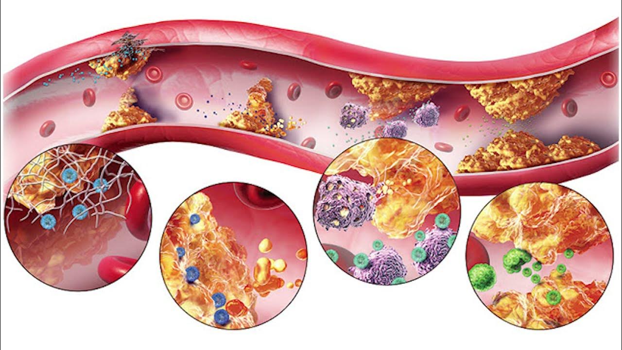 Повышенный холестерин сосуды