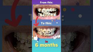 Satisfying 6 month braces timelapse with tips