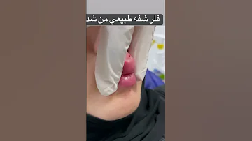 تعليم فلر الشفه خطوه بخطوه 