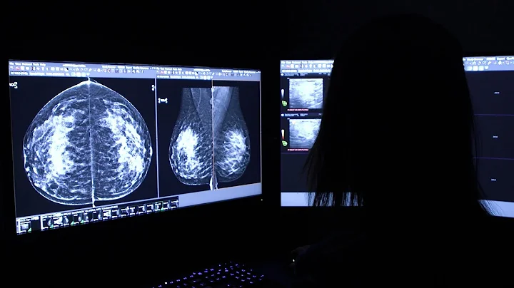 Mayo Clinic Minute - What does a dense breast tissue diagnosis mean?