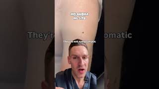Melanoma myth number 3: Melanoma can’t look like a normal mole