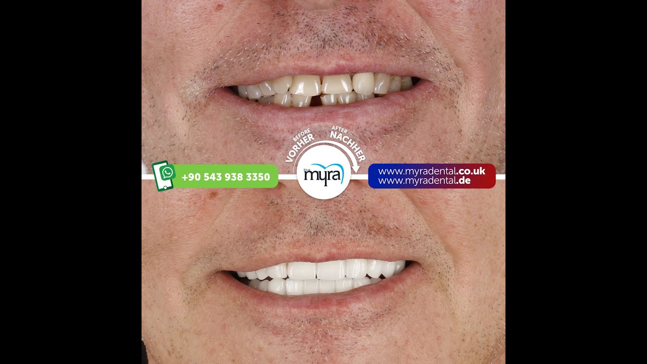 How to Straighten Your Teeth at Myra Dental Clinic - YouTube