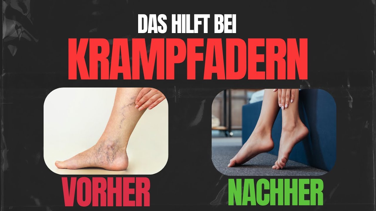 Krampfadern müssen nicht sein 👉 was kannst du tun?