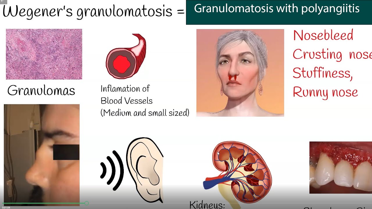Wegener s Granulomatosis Granulomatosis With Polyangiitis Symptoms Wegener s Granulomatosis Granulomatosis With Polyangiitis Symptoms