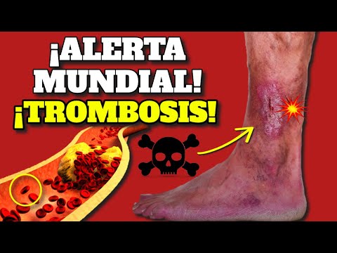 ¡ALERTA MUNDIAL! SURGEN TROMBOSIS COÁGULOS y EMBOLIA| SIGNOS DE ALARMA y COMO PREVENIR TROMBOS